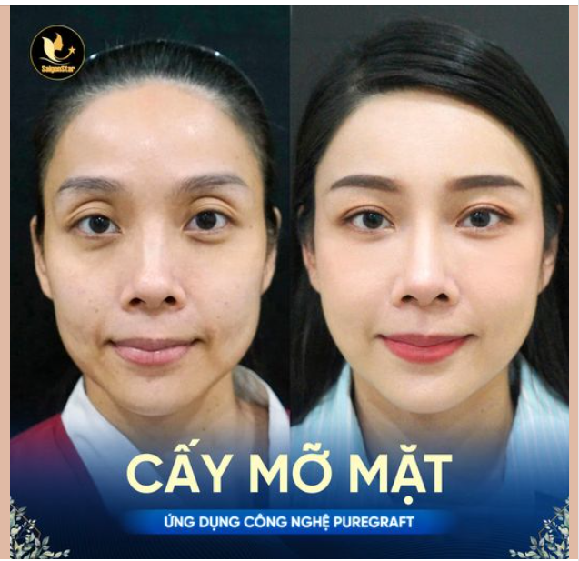 CẤY MỠ TOÀN MẶT - CÔNG NGHỆ PUREGRAFT GƯƠNG MẶT ĐẦY ĐẶN, TƯƠI TRẺ, PHÚC HẬU