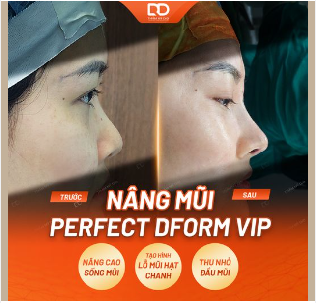 THAY ĐỔI NGỠ NGÀNG DÁNG MŨI VỪA THỰC HIỆN