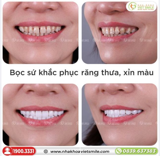 BỌC SỨ KHẮC PHỤC RĂNG THƯA, XỈN MÀU