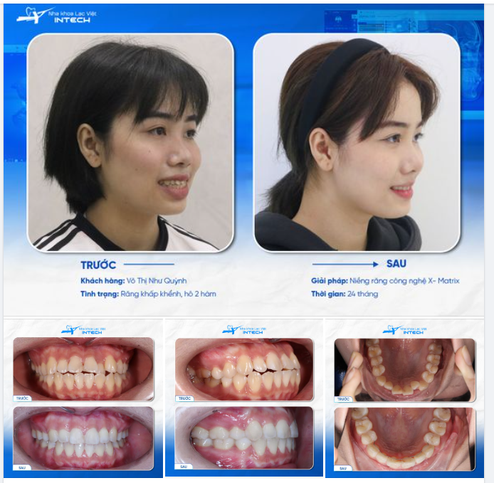 “LÃI” GÓC NGHIÊNG ĐẸP XUẤT SẮC NHỜ NIỀNG RĂNG, CÔ GÁI CÓ MÀN LỘT XÁC ẤN TƯỢNG!