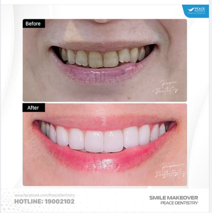 KẾT QUẢ SAU CÙNG CỦA MỘT CA THẨM MỸ RĂNG SỨ