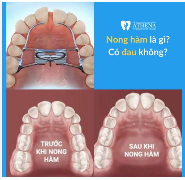 Nong hàm là gì? Có đau không?