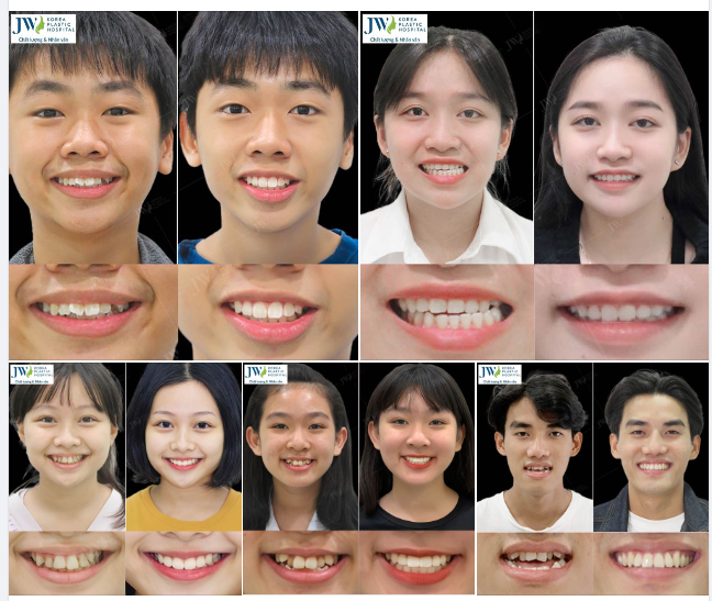 CẢI THIỆN NỤ CƯỜI XINH với Niềng răng SMART dành cho các bạn 6 ĐẾN 18 TUỔI điều chỉnh răng hàm CÀNG SỚM CÀNG TỐT