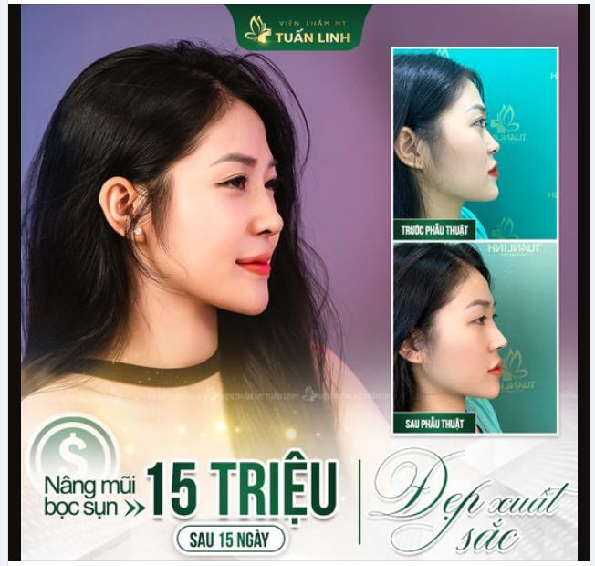 Form mũi theo yêu cầu - Dáng mũi 15 ngày tuổi của bạn khách xinh đẹp nhà Tuấn Linh.