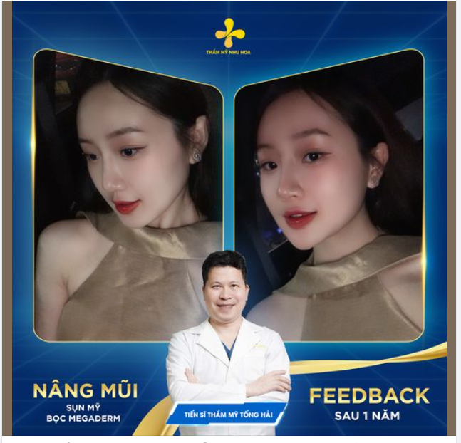 Ảnh mới chụp, còn chưa đăng Facebook cá nhân nhưng đã được bạn Bích Ngọc ưu tiên tặng Thẩm mỹ Như Hoa làm feedback sau 1 năm nâng mũi.