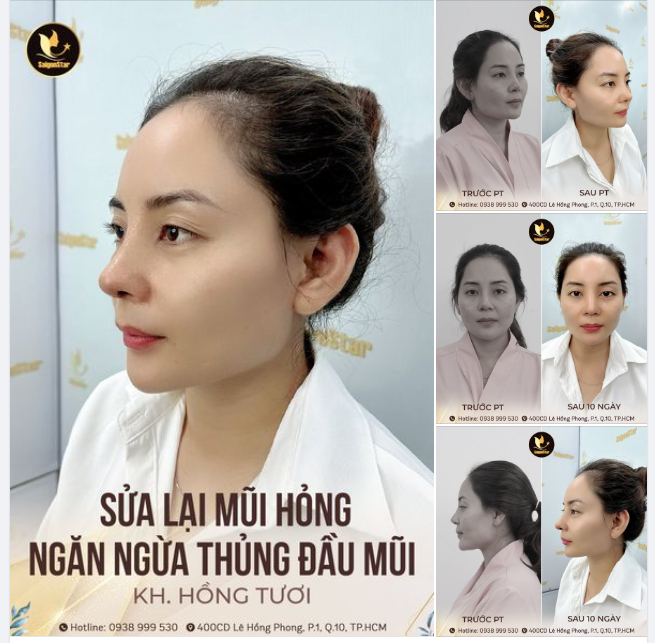 KHOE VỚI CẢ NHÀ HÌNH ẢNH CHỊ HỒNG TƯƠI SAU 10 NGÀY SỬA LẠI MŨI HỎNG