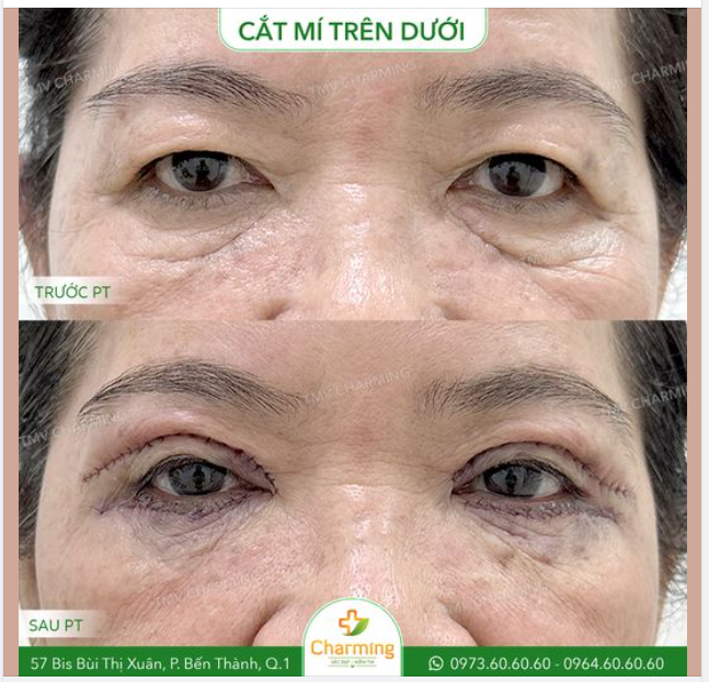 Nếu như càng lớn tuổi mí trên của bạn càng chảy xệ và mí dưới thì có nhiều da chùng, bọng mắt lớn thì sao? Thì cũng không sao vì mọi người có thể thực hiện phẫu thuật cắt mí trên và dưới để giải quyết cùng lúc cả 2 vấn đề này
