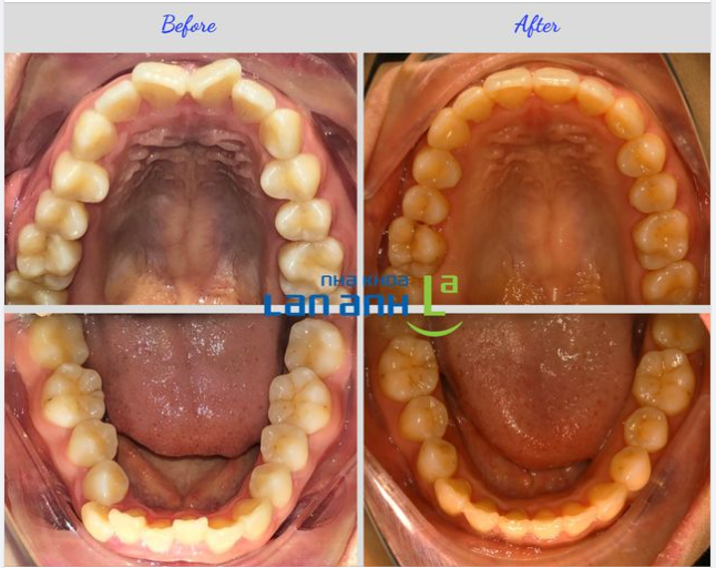 Không dễ, nhưng cũng nên làm, vì giữ lại răng thì sẽ tốt hơn là nhổ răng