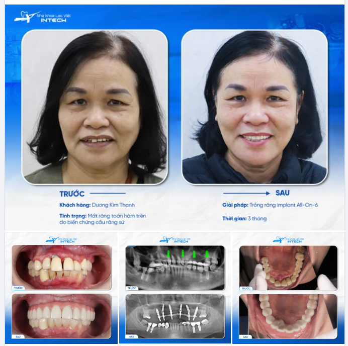 CHẤM DỨT CHUỖI NGÀY ĂN NHAI KHÓ KHĂN NHỜ GIẢI PHÁP DCT