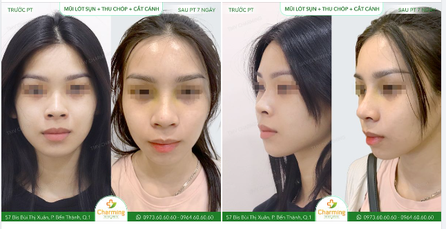 Gương mặt bỗng chốc được nâng cấp chỉ với sự thay đổi nơi chiếc mũi, mọi người có tin được không?