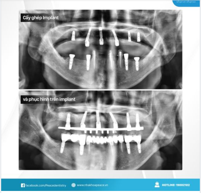 SAU KHI CẤY TRỤ IMPLANT BAO LÂU THÌ MỚI CÓ THỂ CỐ ĐỊNH RĂNG LÊN IMPLANT?