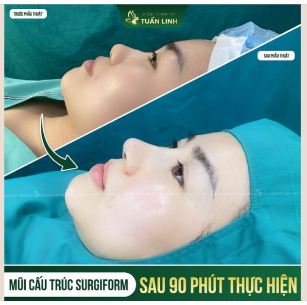 XEM NGAY SỰ THAY ĐỔI CỦA CHIẾC MŨI CHỈ SAU 90 PHÚT!!