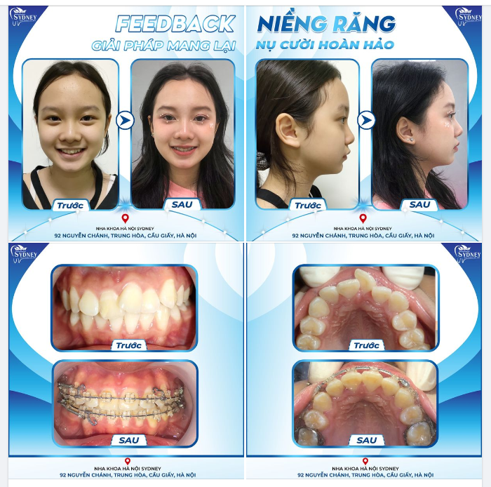 NIỀNG RĂNG – GIẢI PHÁP MANG LẠI NỤ CƯỜI HOÀN HẢO