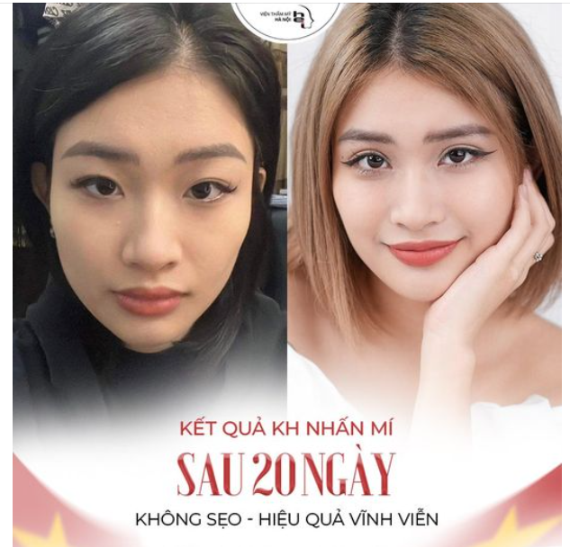 KẾT QUẢ SAU 20 NGÀY NHẤN MÍ TẠI VTMHN SẼ THẾ NÀO?