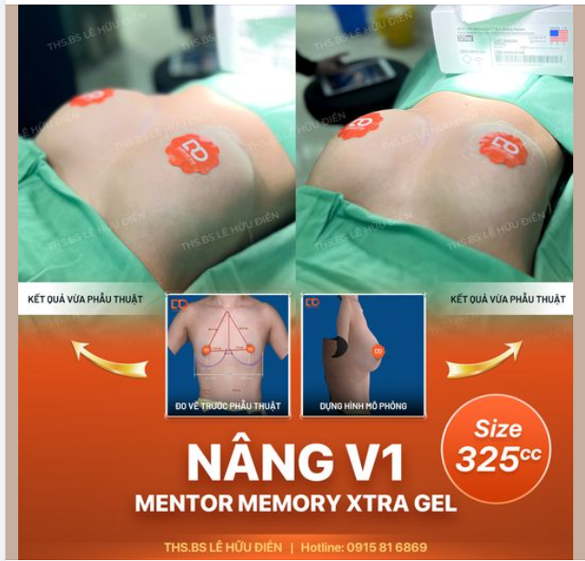 KẾT QUẢ NÂNG NGỰC SAU KHI THỰC HIỆN