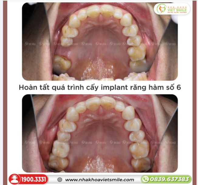 THOẢI MÁI ĂN NHAI SAU TRỒNG IMPLANT PHỤC HỒI RĂNG HÀM SỐ 6