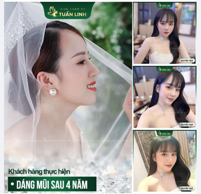 Thế nào là nâng mũi bền đẹp?