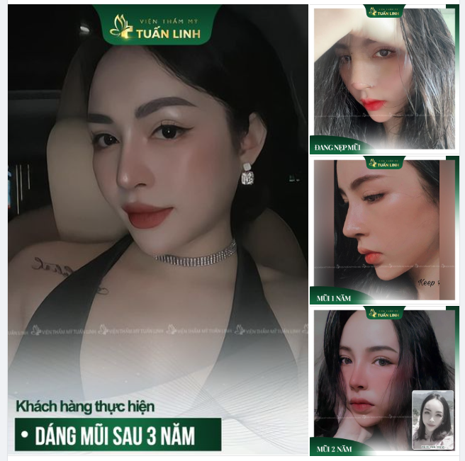 Đẹp sang chảnh cùng Dáng mũi sau 3 năm nâng tại Tuấn Linh!