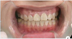 Vì sao phải gắn răng tạm khi trồng răng implant?