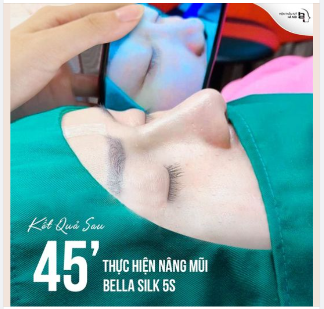 "Sở Hữu Góc Nghiêng Vạn Người Mê" chỉ sau 45' thực hiện nâng mũi Bella Silk 5S