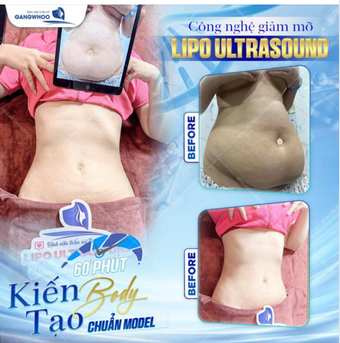 Sau 60 phút, mẹ Hà đã tận mắt chứng kiến bác sĩ đã lấy ra 2.5 lít mỡ thừa bụng, vòng eo thu hồi 12cm.