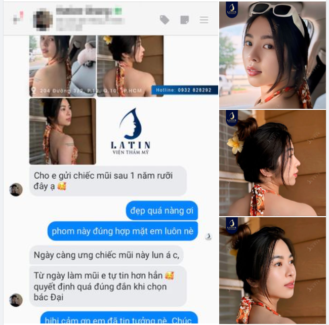 "Từ ngày làm mũi em tự tin hơn..." Mũi làm 1 năm 6 tháng ngày càng tự nhiên, không ai biết là em đã nâng mũi.
