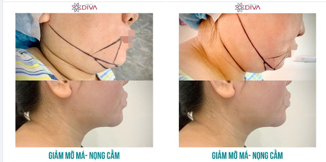 KẾT QUẢ GIẢM MỠ MÁ, NỌNG CẰM SAU THẨM MỸ
