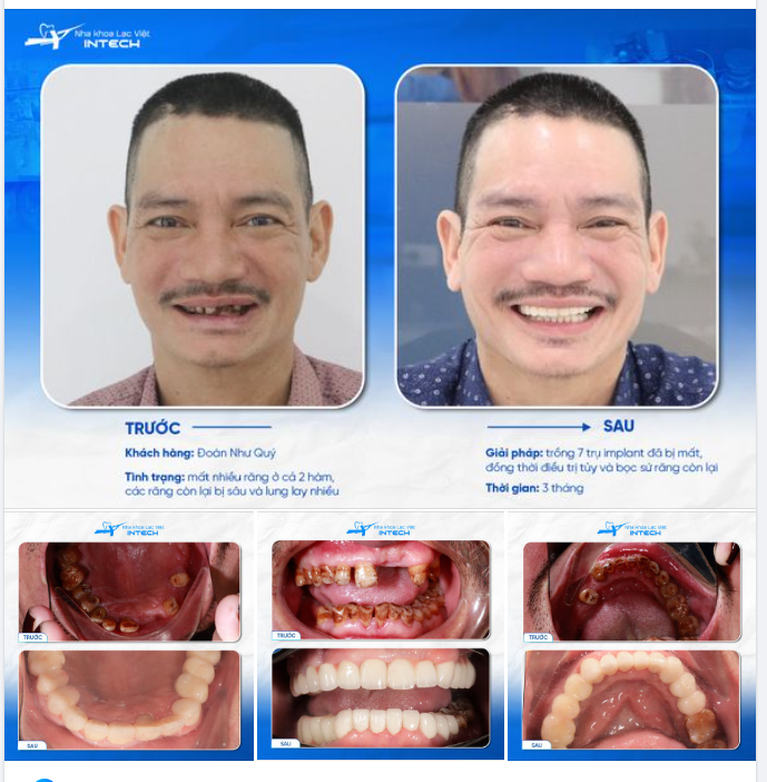 VƯỢT HƠN 100KM TÌM LẠI HÀM RĂNG ƯNG Ý