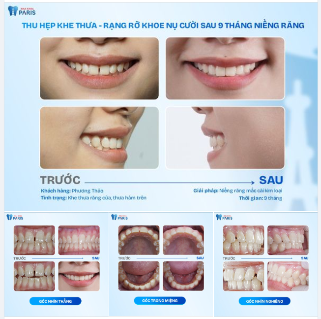 THU HẸP KHE THƯA CHỈ SAU 9 THÁNG NIỀNG RĂNG