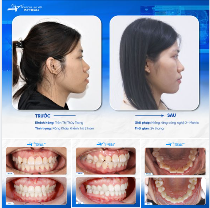 SỞ HỮU GÓC NGHIÊNG THẦN THÁNH NHỜ NIỀNG RĂNG X-MATRIX, CÔ GÁI HẠNH PHÚC VÌ “HẾT HÔ RỒI”!