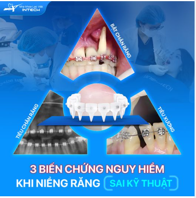 CẢNH BÁO 3 BIẾN CHỨNG NGUY HIỂM KHI NIỀNG RĂNG KHÔNG AN TOÀN