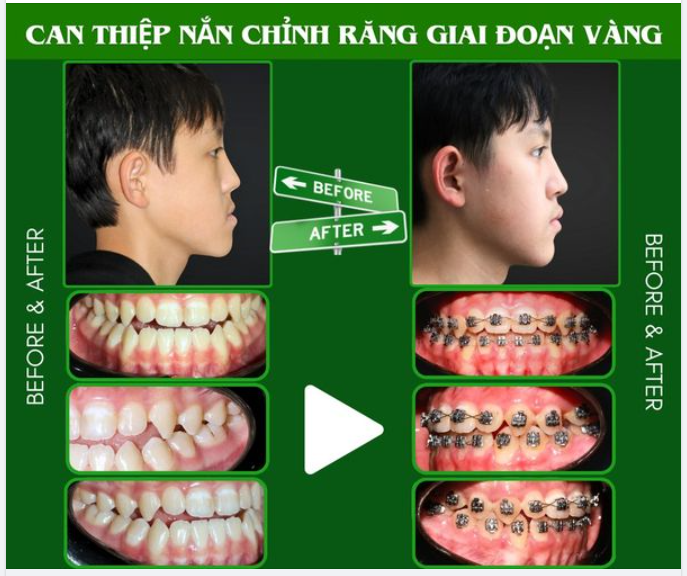 NGỠ NGÀNG VỀ KẾT QUẢ NIỀNG RĂNG SỚM CHO TRẺ