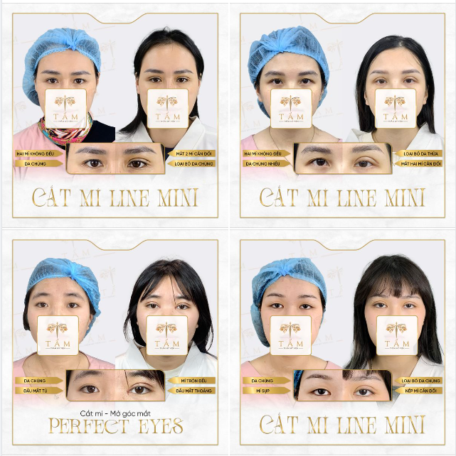 Tại TMV Tấm, một đôi mắt đẹp là : Hai mí mắt to, tròn đều, cân đối. Size mí vừa vặn, fit với tổng thể khuôn mặt, không to trợn, không lật mí. Hoàn toàn KHÔNG SẸO