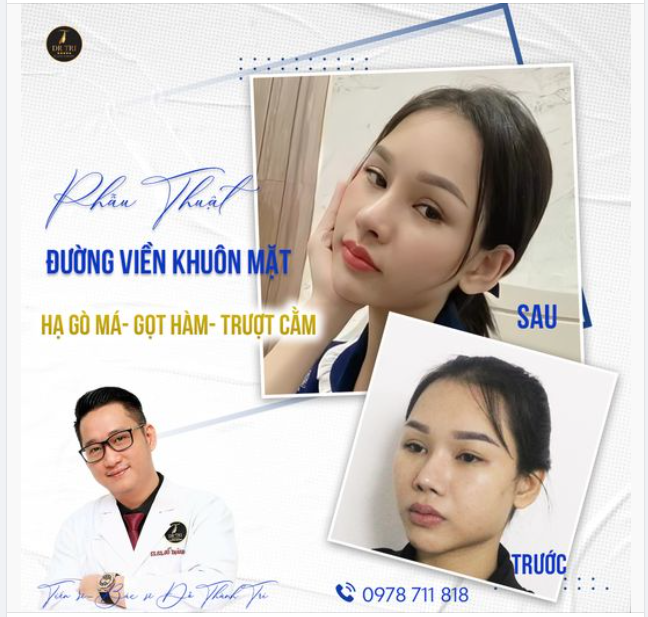 Phẫu thuật Đường Viền Khuôn Mặt Làm 1 lần - ĐẸP 1 đời Kết quả Vĩnh VIỄN!