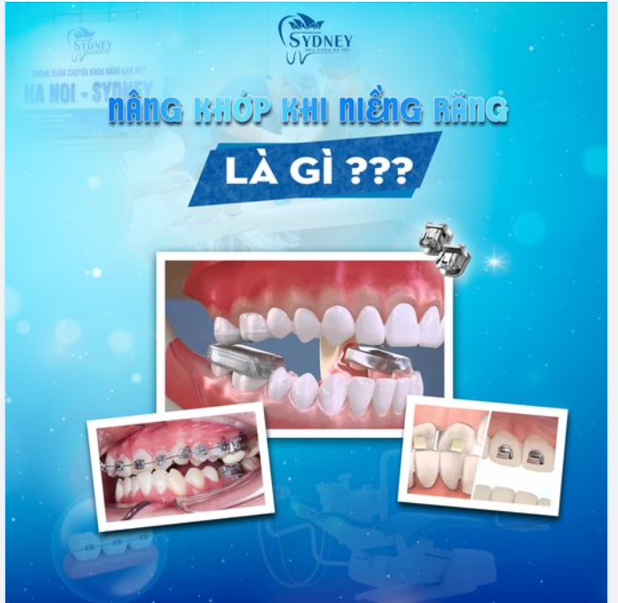 NÂNG KHỚP KHI NIỀNG RĂNG ĐỂ LÀM GÌ?