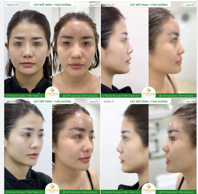 Một gương mặt đầy đặn sẽ giúp bạn trông tràn trề sức sống, tươi tắn và khỏe khoắn hơn.