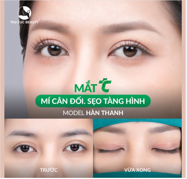 Sở hữu ngay nếp mí sắc nét sau 15P Chọn Mắt TC
