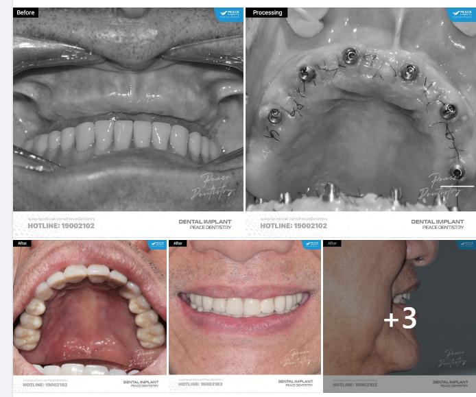 Giải đáp về ca implant nhận được nhiều câu hỏi từ các Cô Chú lớn tuổi, khách hàng Việt Kiều.