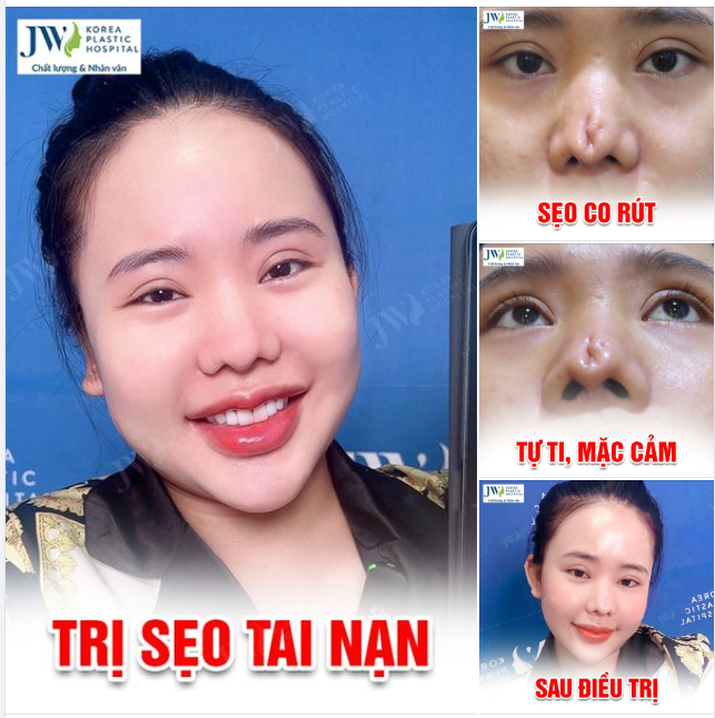 CÔ GÁI XÉM MẤT MŨI VÌ TAI NẠN CHỊ GÁI ĐƯỢC BÁC SĨ TÚ DUNG TÁI TẠO THÀNH CÔNG