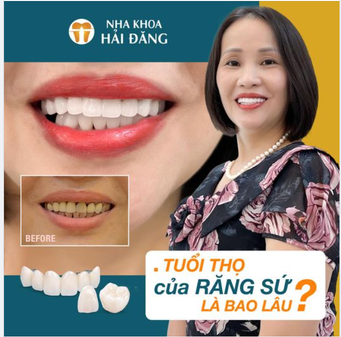 TUỔI THỌ CỦA RĂNG SỨ LÀ BAO LÂU??