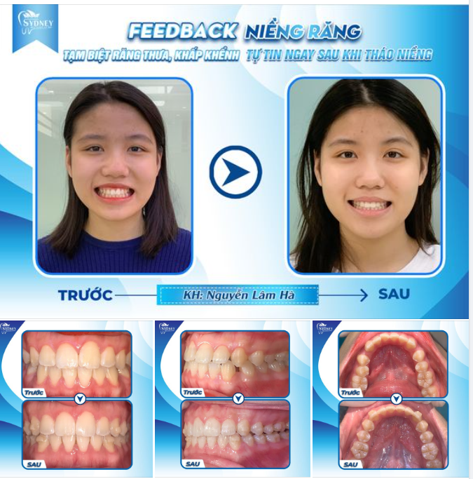 TẠM BIỆT RĂNG THƯA, KHẤP KHỂNH - TỰ TIN NGAY SAU KHI THÁO NIỀNG
