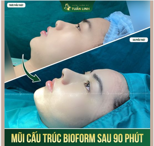 Nâng mũi cấu trúc Bioform Xóa tẹt - Kiến tạo góc nghiêng “đỉnh kout”!