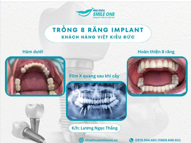 Khách hàng là chú Lương Ngọc Thắng gần 60 tuổi, chú bị cao huyết áp và di chuyển từ Đức về Việt Nam để trồng implant và làm lại răng sứ cũ.