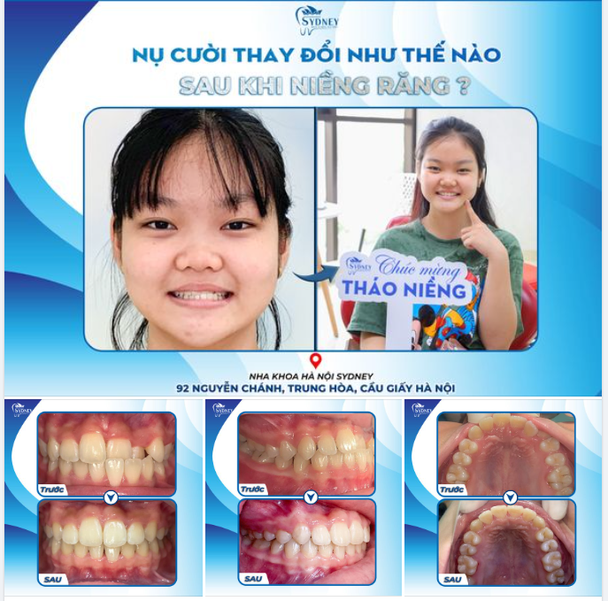 NỤ CƯỜI THAY ĐỔI NHƯ THẾ NÀO SAU KHI NIỀNG RĂNG?
