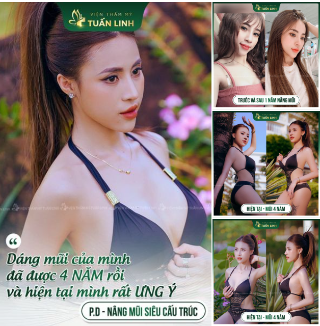  Feedback khách hàng sau 4 năm nâng mũi tại Tuấn Linh!!