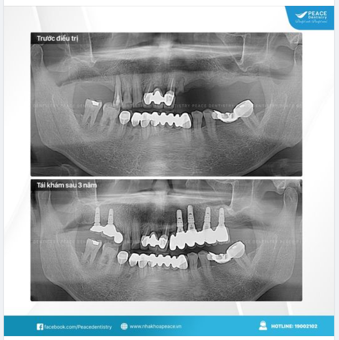 TÁI KHÁM SAU 3 NĂM TRỒNG RĂNG IMPLANT TẠI PEACE DENTISTRY