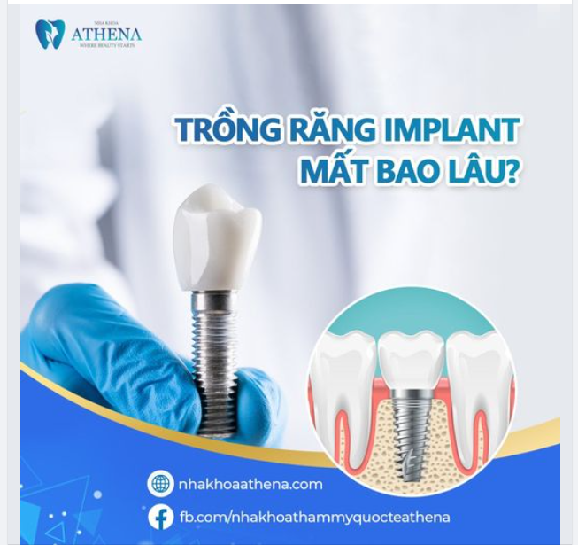 Trồng răng implant mất bao lâu?