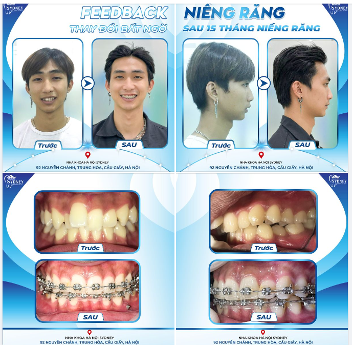 THAY ĐỔI BẤT NGỜ SAU 15 THÁNG NIỀNG RĂNG