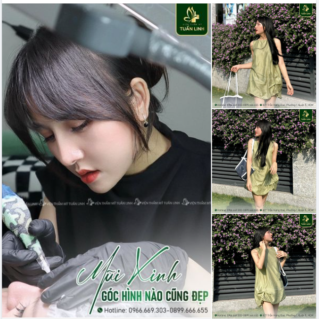 Tự Tin Khoe Mọi Góc Hình Sau Nâng Mũi Cấu trúc.