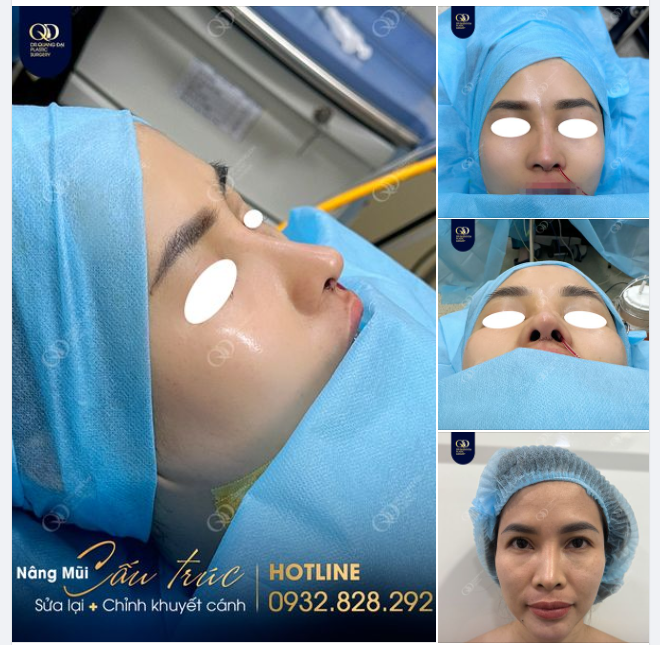 Khắc phục mũi lộ sóng bóng đỏ, co rút đầu mũi cho chị gái